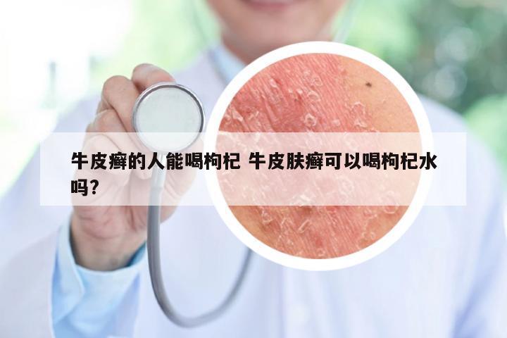 牛皮癣的人能喝枸杞 牛皮肤癣可以喝枸杞水吗?
