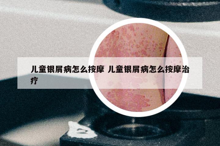 儿童银屑病怎么按摩 儿童银屑病怎么按摩治疗