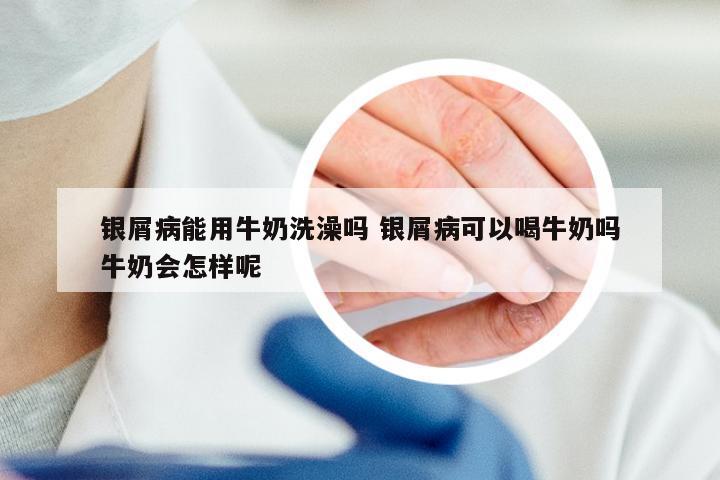 银屑病能用牛奶洗澡吗 银屑病可以喝牛奶吗牛奶会怎样呢