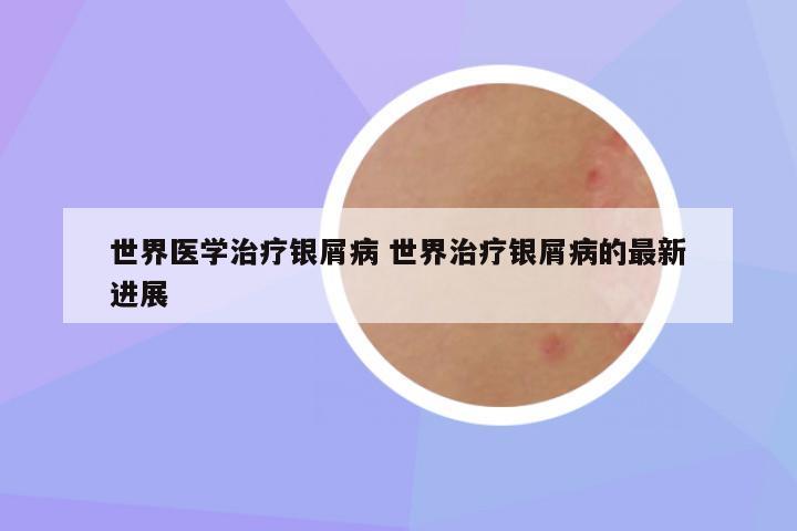 世界医学治疗银屑病 世界治疗银屑病的最新进展