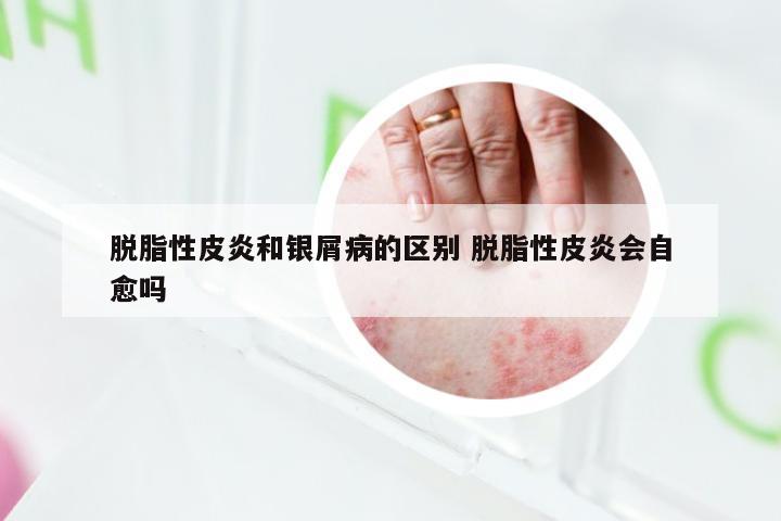 脱脂性皮炎和银屑病的区别 脱脂性皮炎会自愈吗