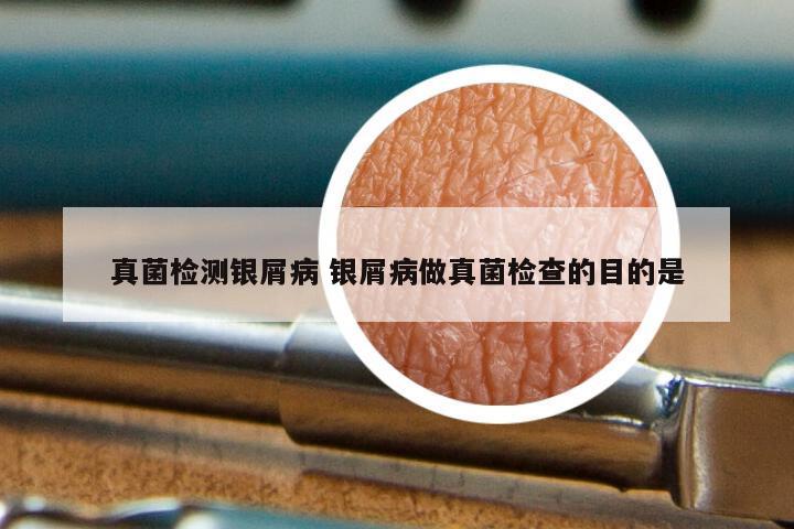 真菌检测银屑病 银屑病做真菌检查的目的是