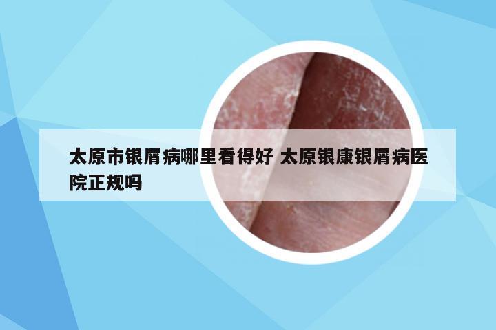 太原市银屑病哪里看得好 太原银康银屑病医院正规吗