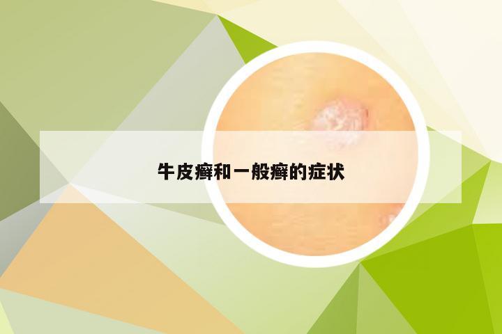 牛皮癣和一般癣的症状