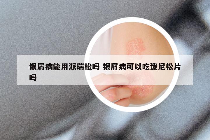 银屑病能用派瑞松吗 银屑病可以吃泼尼松片吗