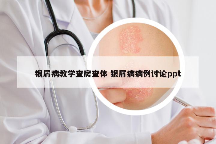 银屑病教学查房查体 银屑病病例讨论ppt