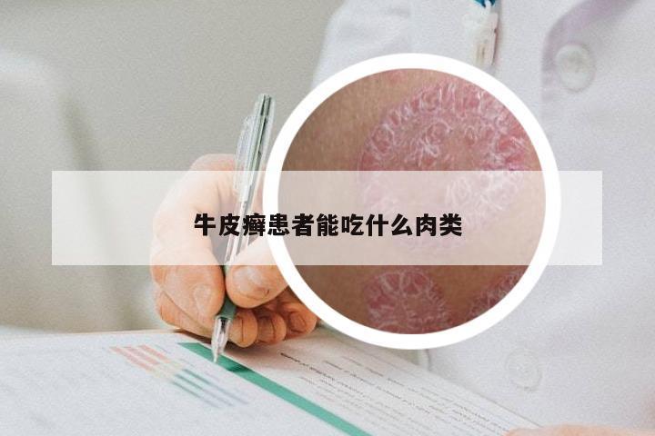 牛皮癣患者能吃什么肉类