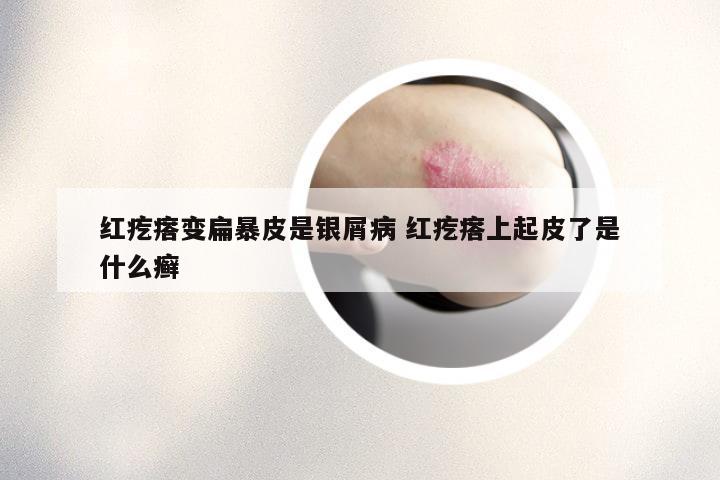 红疙瘩变扁暴皮是银屑病 红疙瘩上起皮了是什么癣