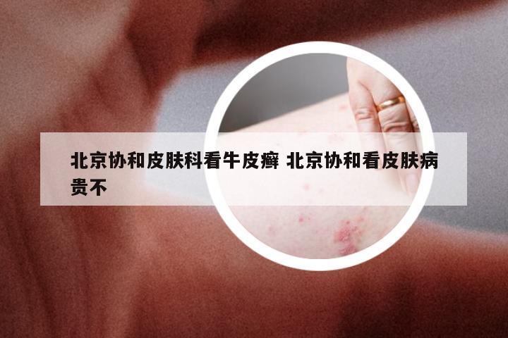 北京协和皮肤科看牛皮癣 北京协和看皮肤病贵不
