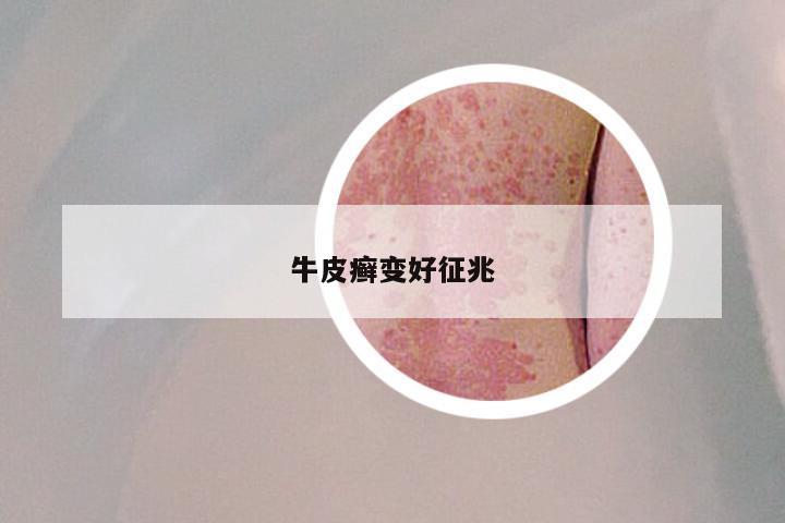 牛皮癣变好征兆