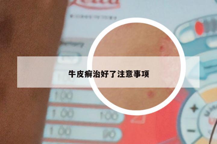 牛皮癣治好了注意事项