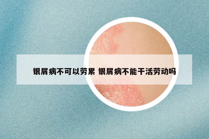 银屑病不可以劳累 银屑病不能干活劳动吗