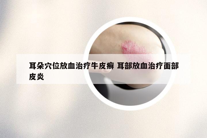 耳朵穴位放血治疗牛皮癣 耳部放血治疗面部皮炎