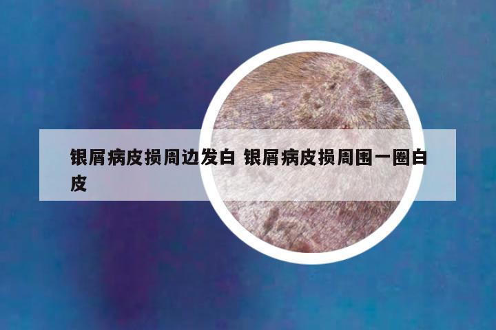 银屑病皮损周边发白 银屑病皮损周围一圈白皮