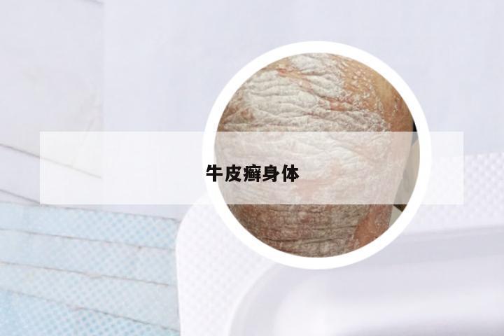 牛皮癣身体