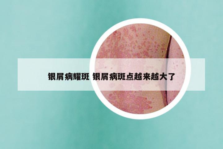 银屑病耀斑 银屑病斑点越来越大了