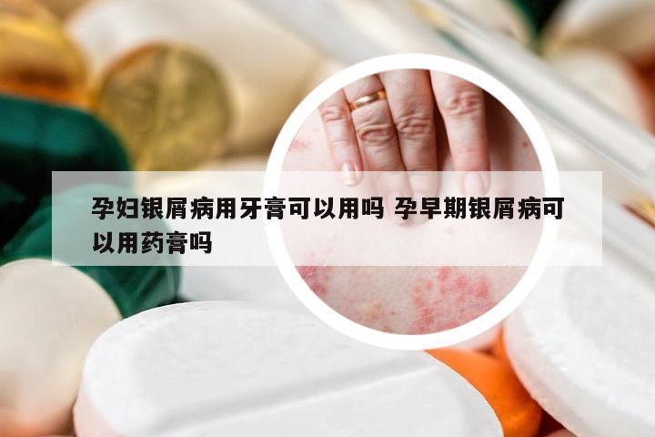 孕妇银屑病用牙膏可以用吗 孕早期银屑病可以用药膏吗