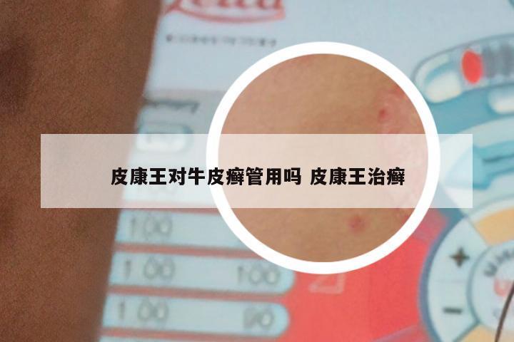 皮康王对牛皮癣管用吗 皮康王治癣