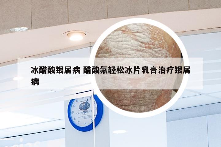 冰醋酸银屑病 醋酸氟轻松冰片乳膏治疗银屑病