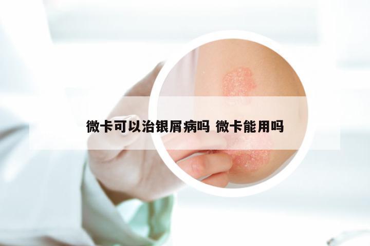 微卡可以治银屑病吗 微卡能用吗