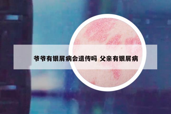 爷爷有银屑病会遗传吗 父亲有银屑病