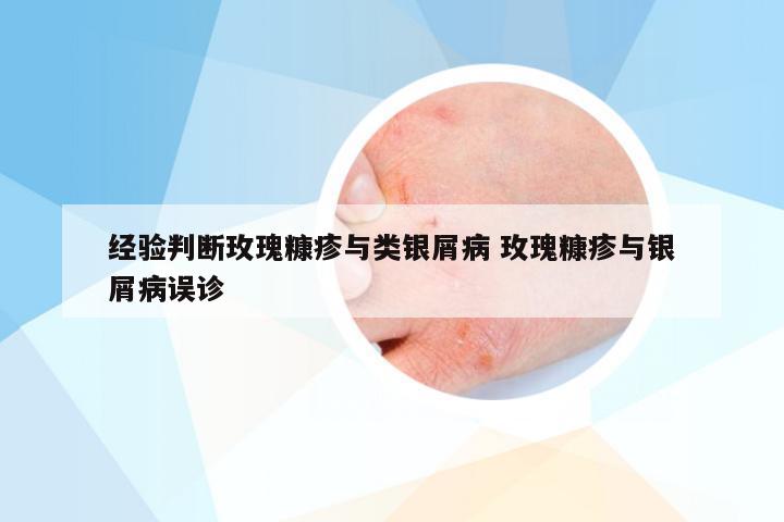 经验判断玫瑰糠疹与类银屑病 玫瑰糠疹与银屑病误诊