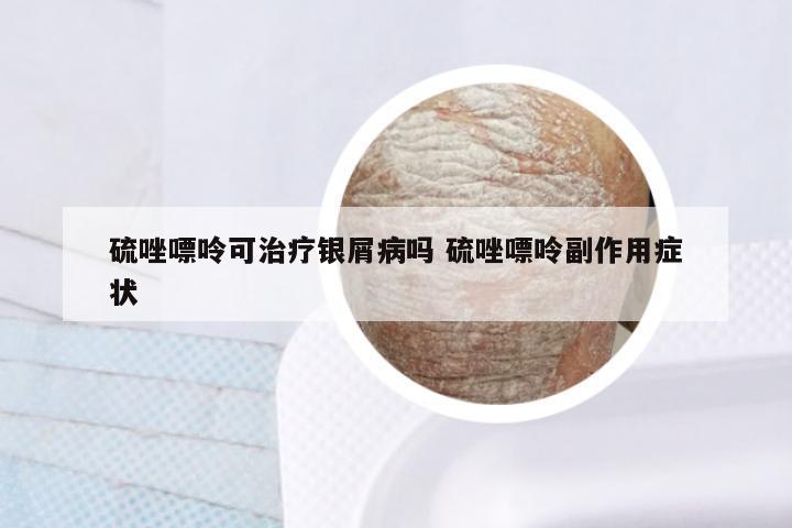 硫唑嘌呤可治疗银屑病吗 硫唑嘌呤副作用症状