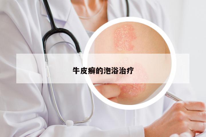 牛皮癣的泡浴治疗