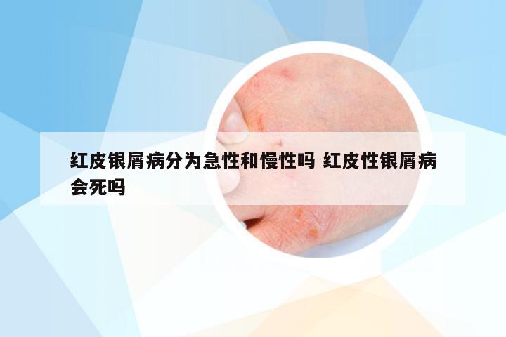 红皮银屑病分为急性和慢性吗 红皮性银屑病会死吗
