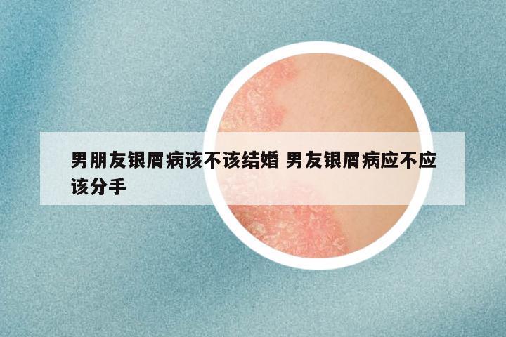 男朋友银屑病该不该结婚 男友银屑病应不应该分手
