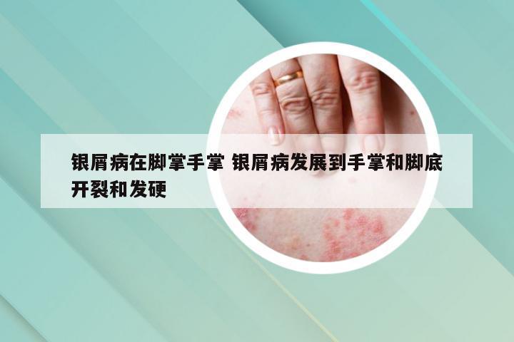 银屑病在脚掌手掌 银屑病发展到手掌和脚底开裂和发硬