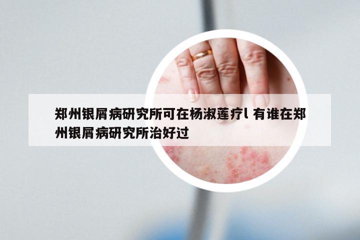 郑州银屑病研究所可在杨淑莲疗l 有谁在郑州银屑病研究所治好过