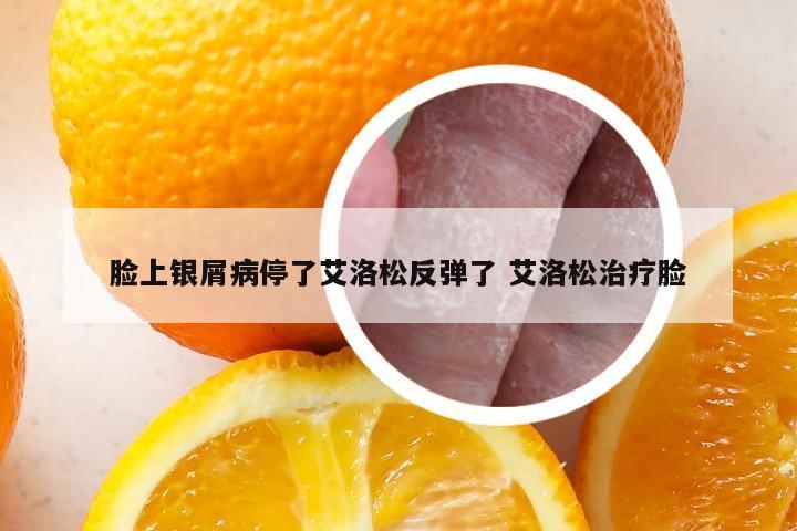 脸上银屑病停了艾洛松反弹了 艾洛松治疗脸