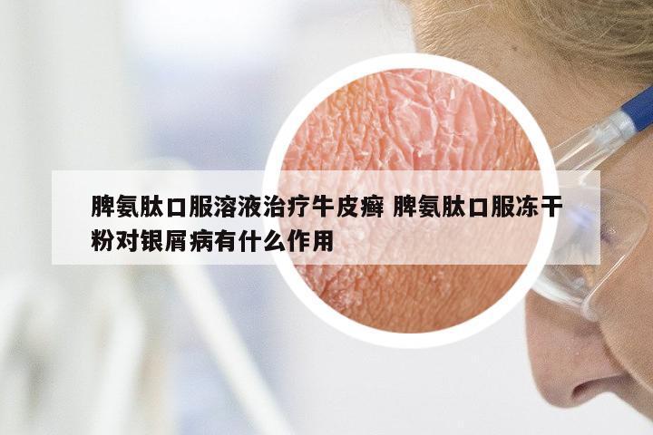 脾氨肽口服溶液治疗牛皮癣 脾氨肽口服冻干粉对银屑病有什么作用