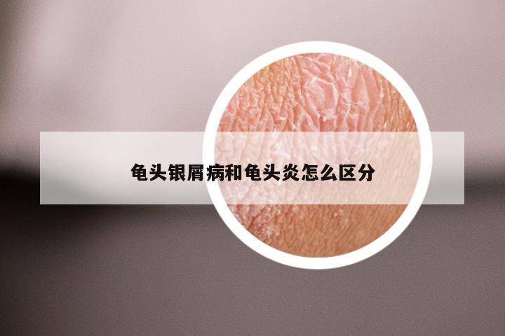 龟头银屑病和龟头炎怎么区分