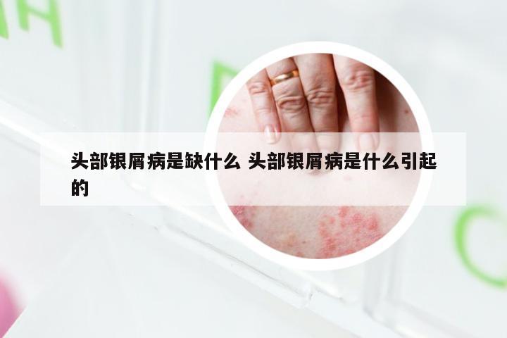头部银屑病是缺什么 头部银屑病是什么引起的