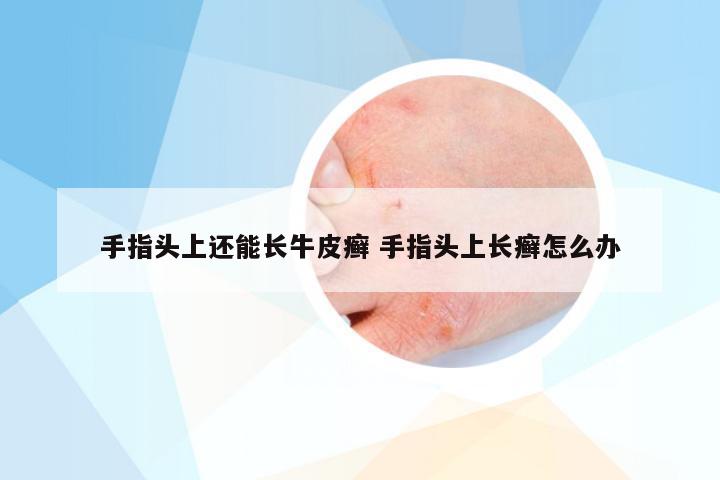 手指头上还能长牛皮癣 手指头上长癣怎么办