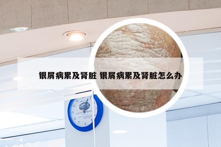 银屑病累及肾脏 银屑病累及肾脏怎么办