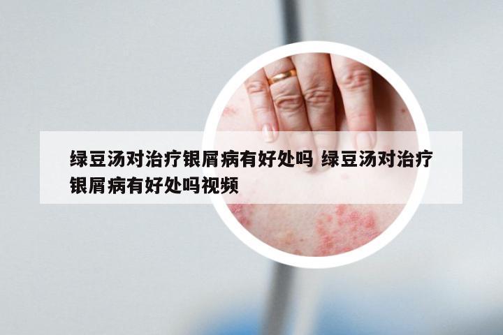 绿豆汤对治疗银屑病有好处吗 绿豆汤对治疗银屑病有好处吗视频