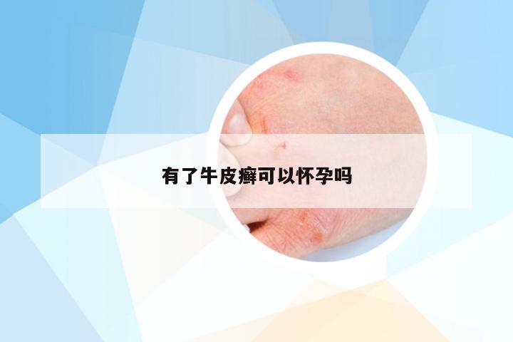 有了牛皮癣可以怀孕吗