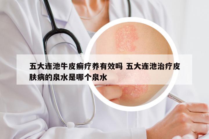 五大连池牛皮癣疗养有效吗 五大连池治疗皮肤病的泉水是哪个泉水