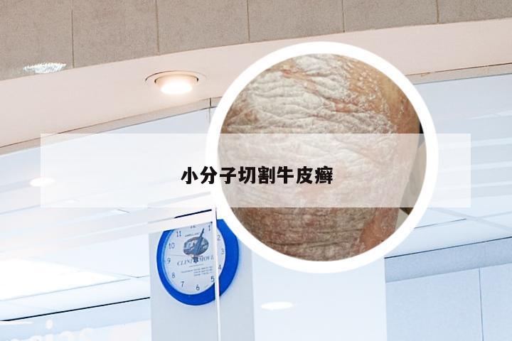 小分子切割牛皮癣