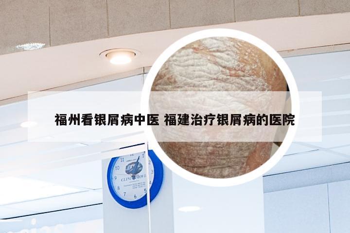 福州看银屑病中医 福建治疗银屑病的医院