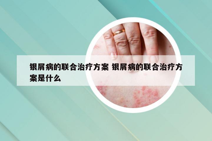 银屑病的联合治疗方案 银屑病的联合治疗方案是什么