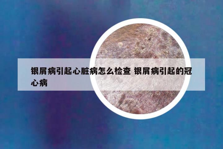 银屑病引起心脏病怎么检查 银屑病引起的冠心病