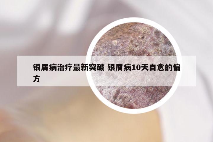 银屑病治疗最新突破 银屑病10天自愈的偏方