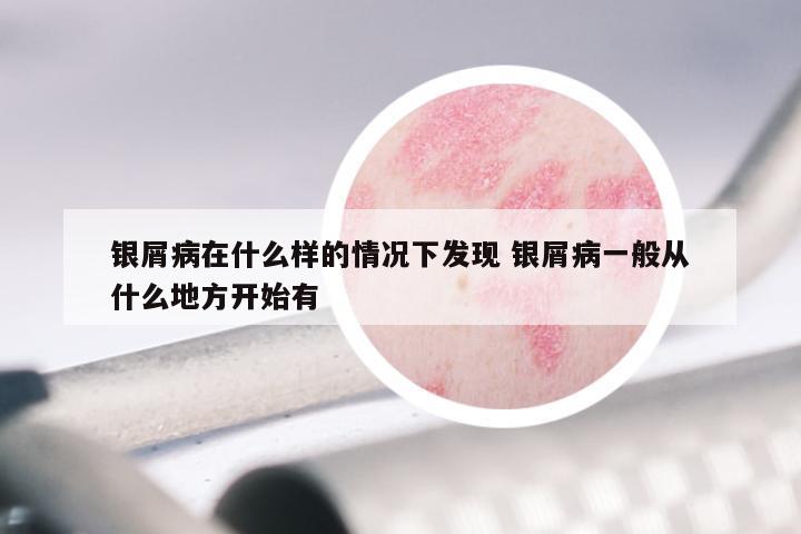银屑病在什么样的情况下发现 银屑病一般从什么地方开始有