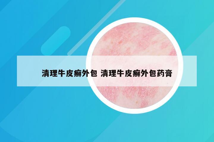 清理牛皮癣外包 清理牛皮癣外包药膏
