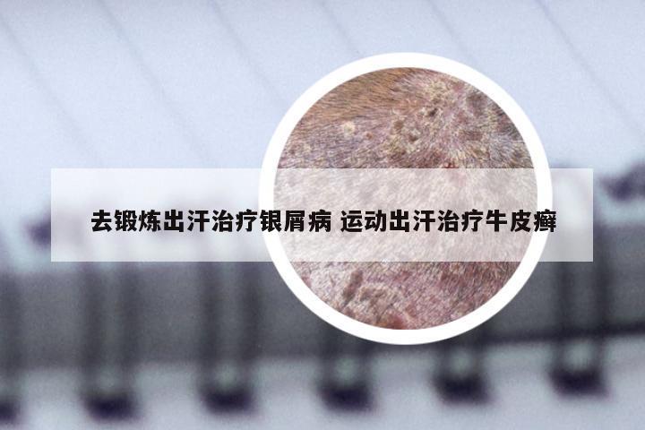 去锻炼出汗治疗银屑病 运动出汗治疗牛皮癣