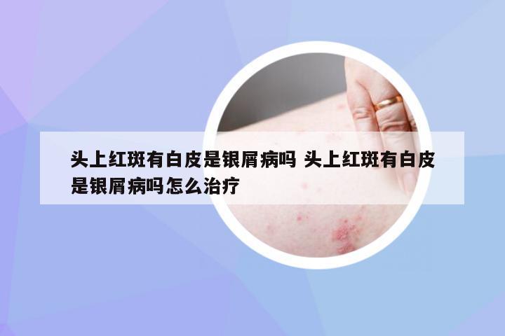 头上红斑有白皮是银屑病吗 头上红斑有白皮是银屑病吗怎么治疗